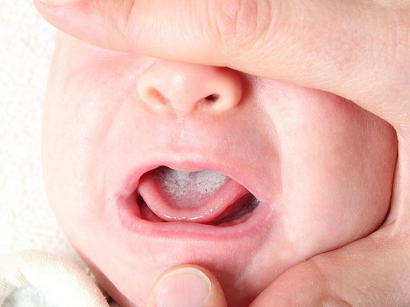 Nhiễm khuẩn khoang miệng có thể là lý do khiến trẻ nhỏ chậm mọc răng
