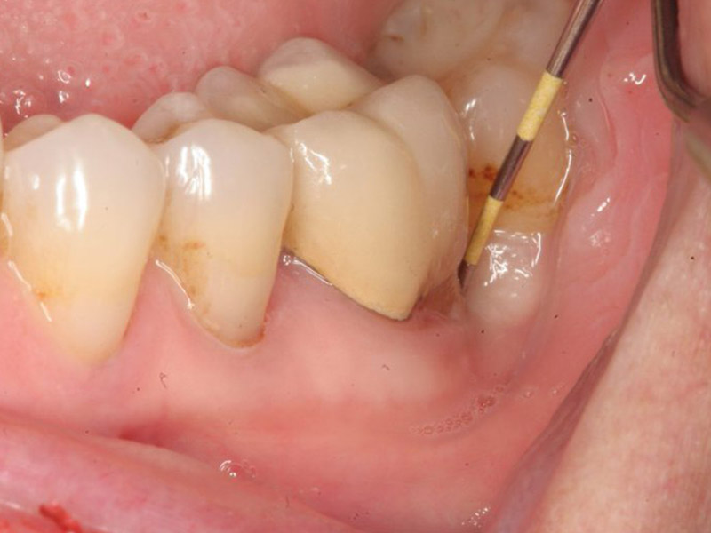 Chậm mọc răng có thể gây ra một số vấn đề liên quan tới vệ sinh răng miệng của trẻ sau này