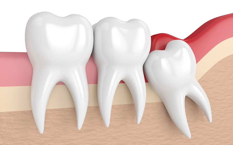 Viêm lợi trùm là bệnh lý liên quan tới sự phát triển của răng khôn