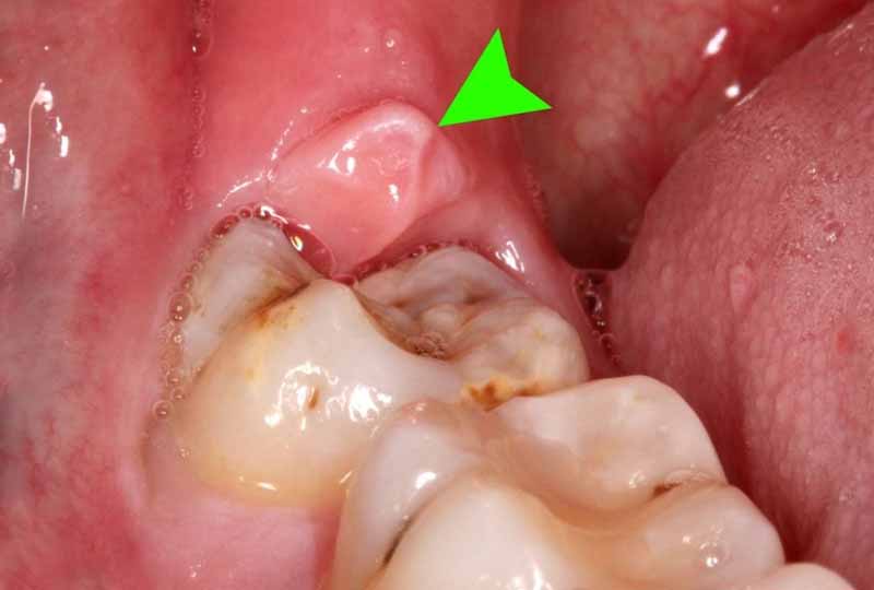 Viêm lợi trùm răng khôn gây ra các biến chứng nguy hiểm cho sức khỏe người bệnh
