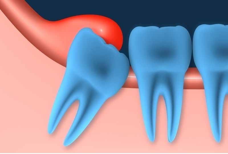 Viêm lợi trùm là tình trạng hay gặp phải khi mọc răng khôn
