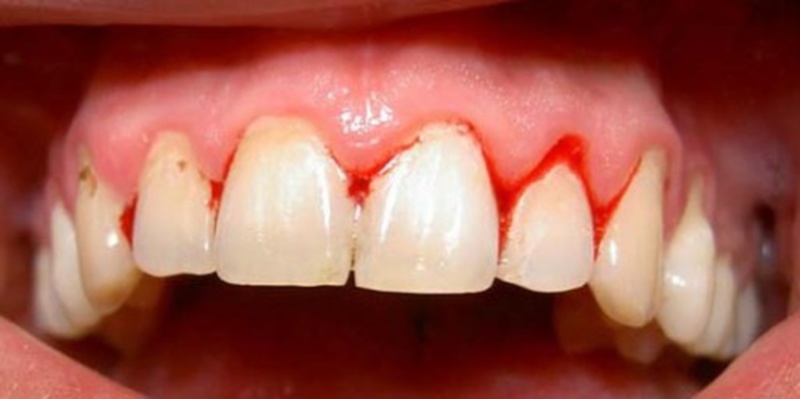 Người bị viêm nha chu khi niềng răng có nguy cơ cao gây mất thẩm mỹ hàm răng