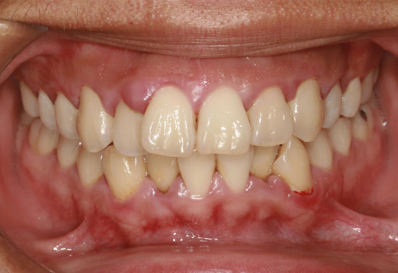 Vệ sinh răng miệng kém là nguyên nhân chủ yếu dẫn đến viêm nha chu