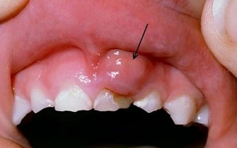 Viêm nướu răng gây ra tình trạng phồng rộp và sưng đỏ nướu