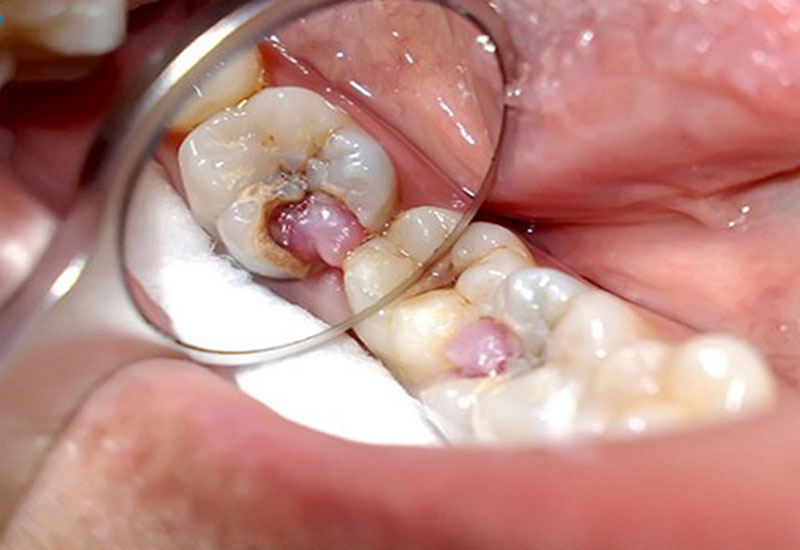 Hình ảnh răng hàm bị viêm tủy gây đau nhức