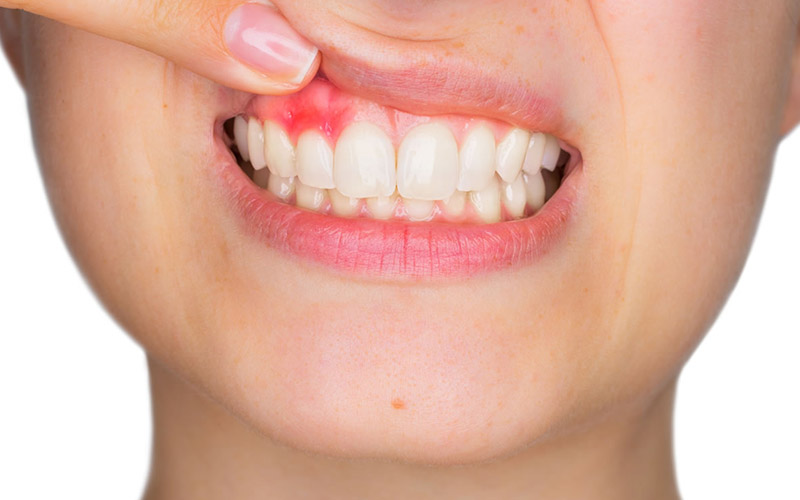 Sưng đỏ ở lợi là dấu hiệu cho thấy người bệnh đang gặp vấn đề về răng miệng