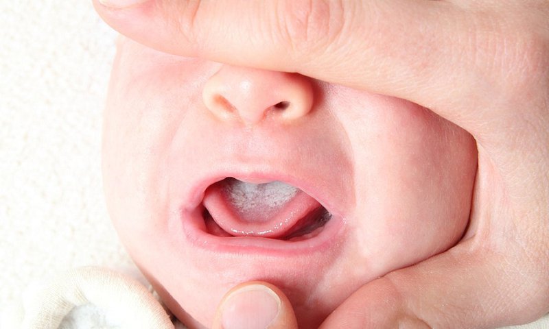 bệnh nấm miệng ở trẻ em