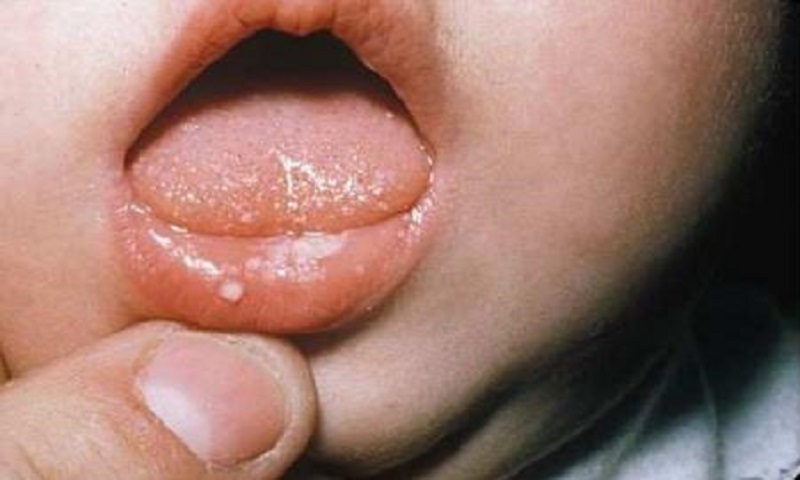 nguyên nhân gây nấm miệng trẻ nhỏ