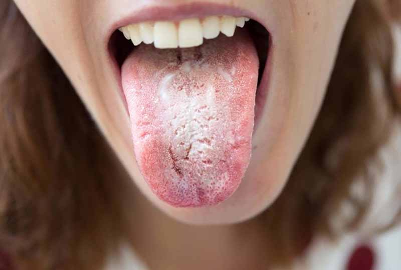 Tưa miệng là triệu chứng thường gặp ở phụ nữ mang thai