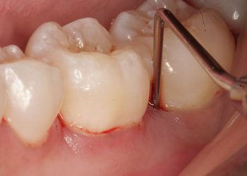 Tình trạng viêm lợi chảy máu chân răng