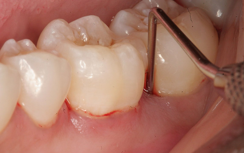 Tình trạng viêm lợi chảy máu chân răng 