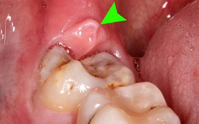 Viêm lợi trùm có mủ là bệnh lý liên quan tới sự phát triển của răng khôn