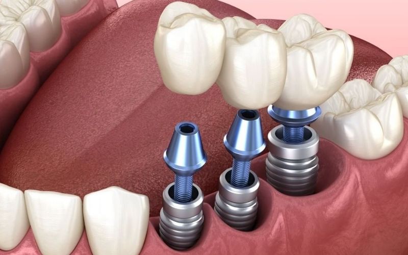 Trồng răng implant có mức chi phí tương đối cao do nguồn nguyên vật liệu đảm bảo chất lượng, có thời hạn bảo hành lên đến trọn đời