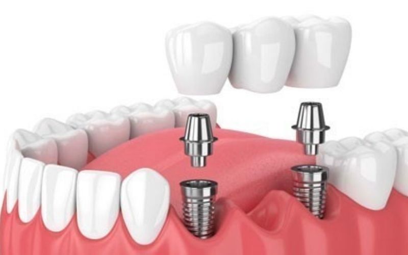 Nếu răng mất liền kề nhau người bệnh có thể sử dụng phương pháp làm cầu răng sứ