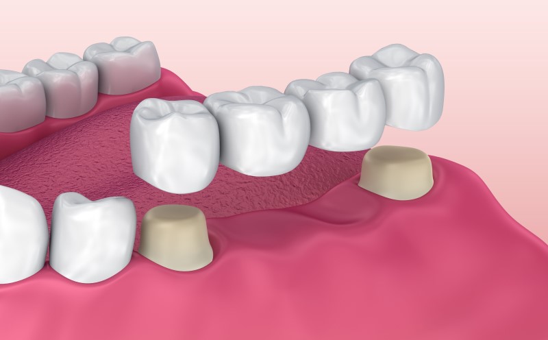 Trồng răng hàm số 7 bằng cầu răng sứ là phương pháp nha khoa phổ biến hiện nay