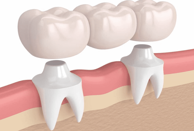 Chi phí trồng răng số 7 bằng cầu răng sứ sẽ phụ thuộc vào nhiều yếu tố khác nhau