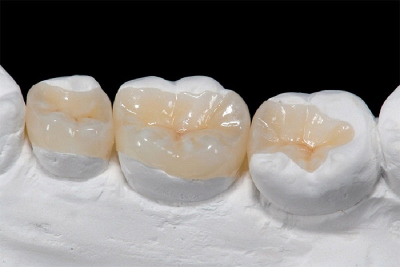 Người bệnh sẽ được chỉ định trám răng để ngưng tình trạng sâu răng