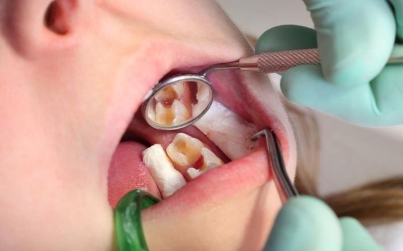 Điều trị tủy là phương pháp tối ưu giúp bảo tồn răng và đặc biệt chấm dứt cơn đau kéo dài do viêm tủy gây ra.