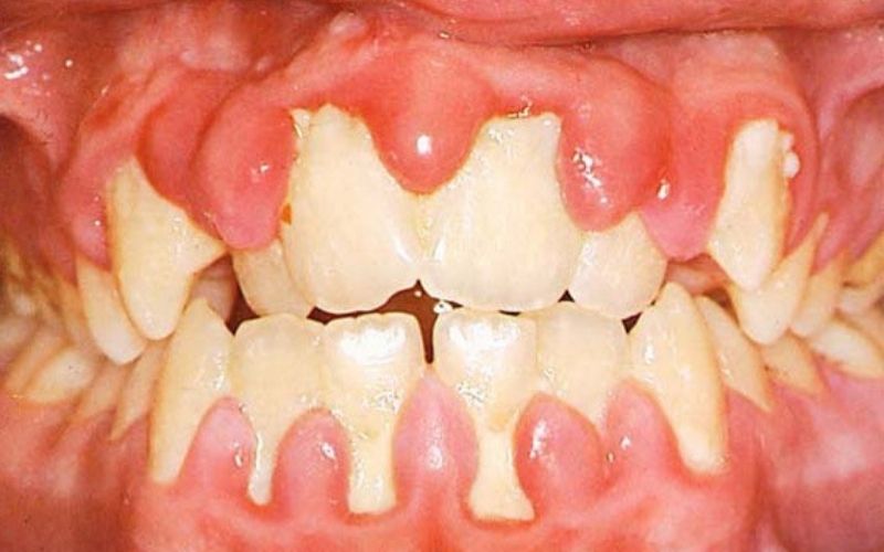 Đau răng dẫn đến đau đầu có khả năng người bệnh bị viêm lợi