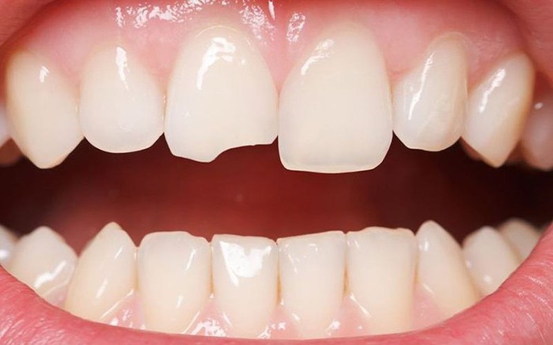 Tình trạng răng bị sứt mẻ cũng gây tổn thương đến răng tạo cảm giác đau nhức răng về đêm