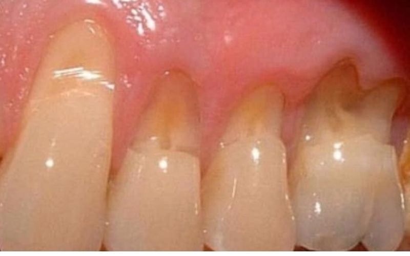 Mòn cổ răng làm giảm men răng gây ê buốt răng khi uống nước lạnh