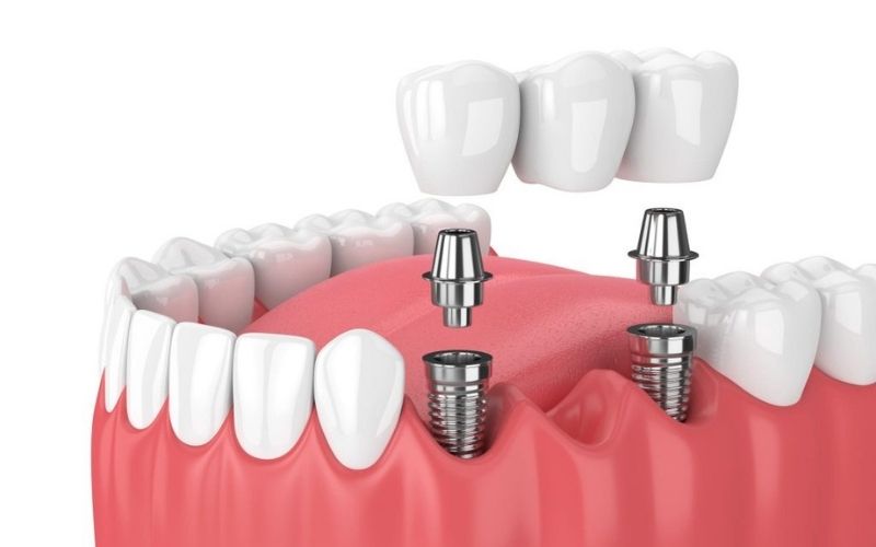 Giá trồng răng giả bằng cấy ghép Implant cao nhất trong số các phương pháp làm răng hiện nay