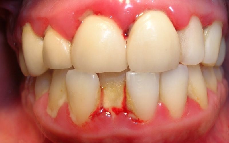 Bệnh nhân mắc bệnh lý viêm nha chu cần được điều trị khỏi trước khi làm răng giả