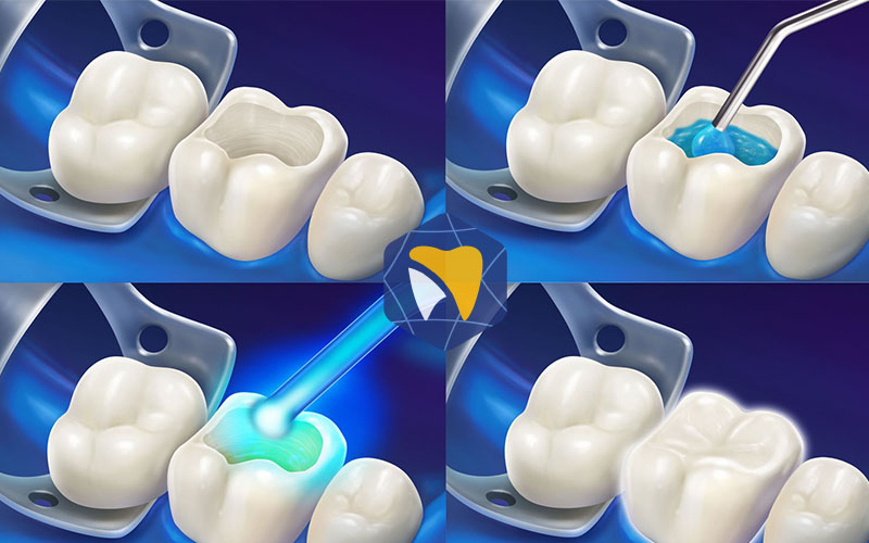 Quy trình hàn trám răng tiêu chuẩn tại ViDental