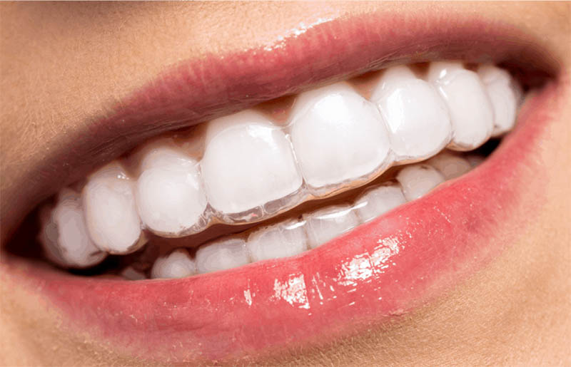 Phương pháp này giải quyết hầu hết các vấn đề về thẩm mỹ răng miệng