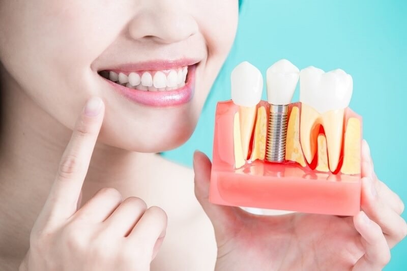 Tìm hiểu và lựa chọn những địa chỉ nha khoa thực hiện trồng răng trả góp implant uy tín