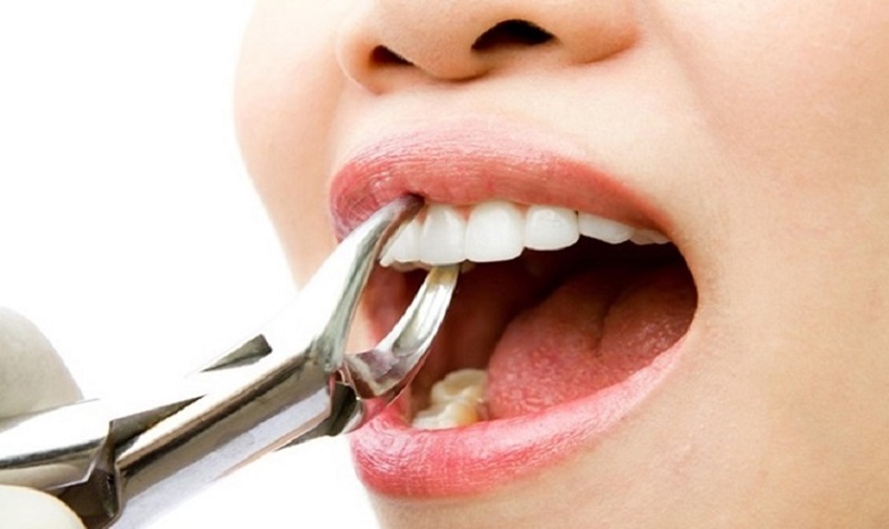 Nhổ răng bao lâu thì trồng răng giả được là vấn đề rất nhiều người quan tâm