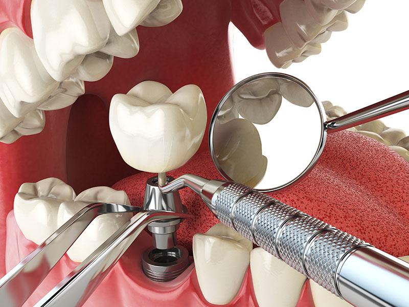 Trồng răng giả sau khi nhổ sẽ giúp bạn tránh được tình trạng mất thẩm mỹ răng miệng