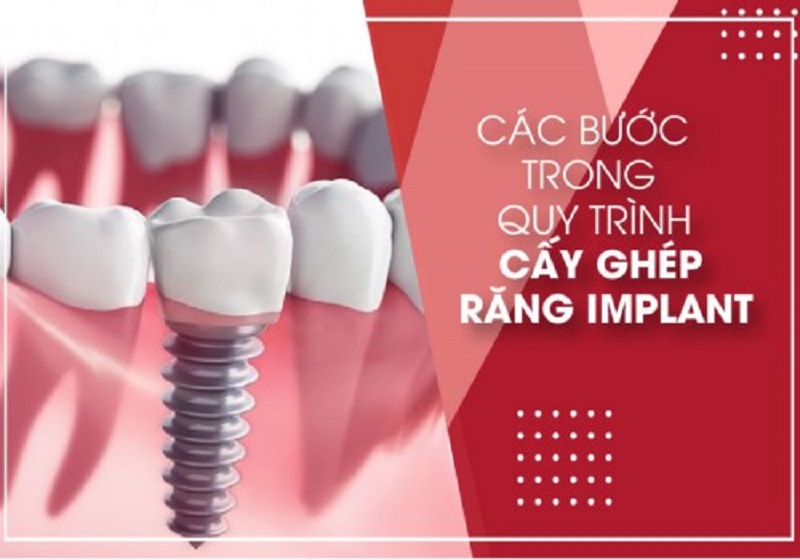Quy trình trồng răng implant gồm có 5 bước cơ bản