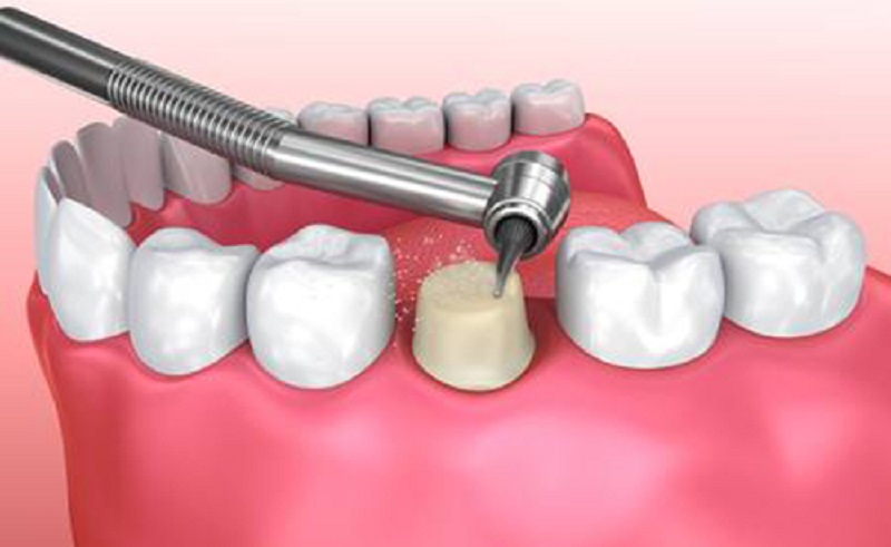 Mài răng với độ mỏng, dày nhất định tùy theo tình trạng của từng bệnh nhân