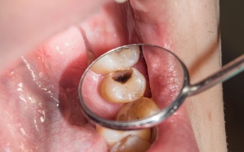 Nếu nghĩ sâu răng là bệnh lý đơn giản, có thể bạn đã sai lầm