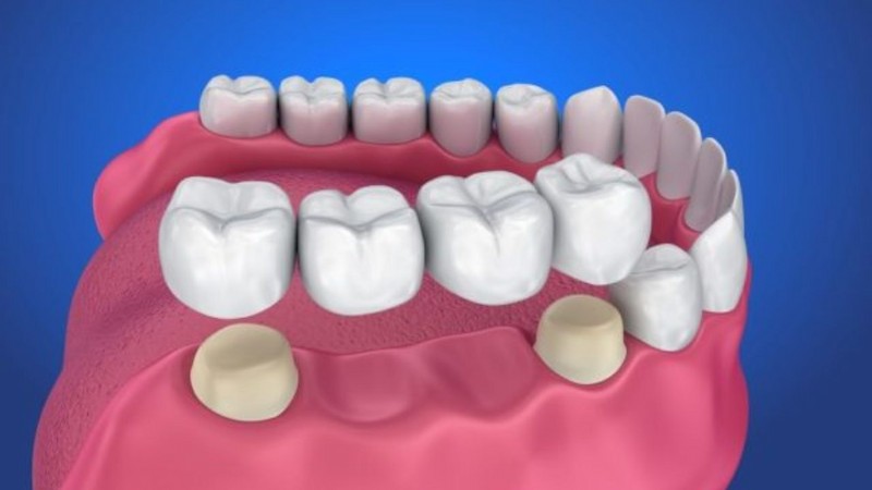 Có thể sử dụng phương pháp cầu răng sứ để khôi phục răng đã mất