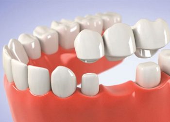 Trồng răng bắc cầu là giải pháp giúp khôi phục tính thẩm mỹ và khả năng ăn nhai tốt
