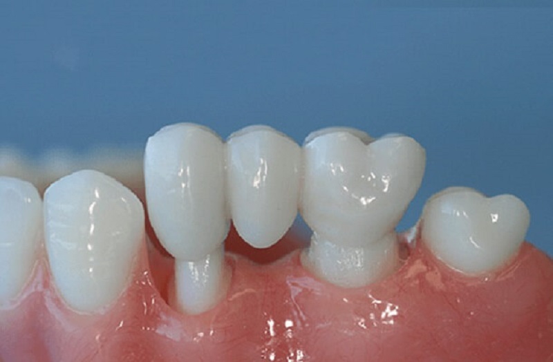 Trồng răng bắc cầu có tuổi thọ cao hay không tùy thuộc vào việc chăm sóc răng miệng của từng người