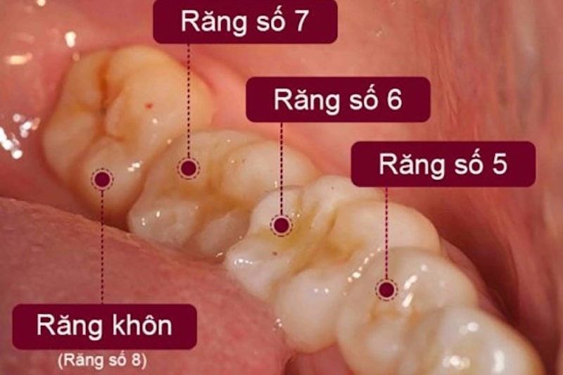 Răng cấm là răng hàm số 6 chỉ mọc duy nhất một lần trong đời