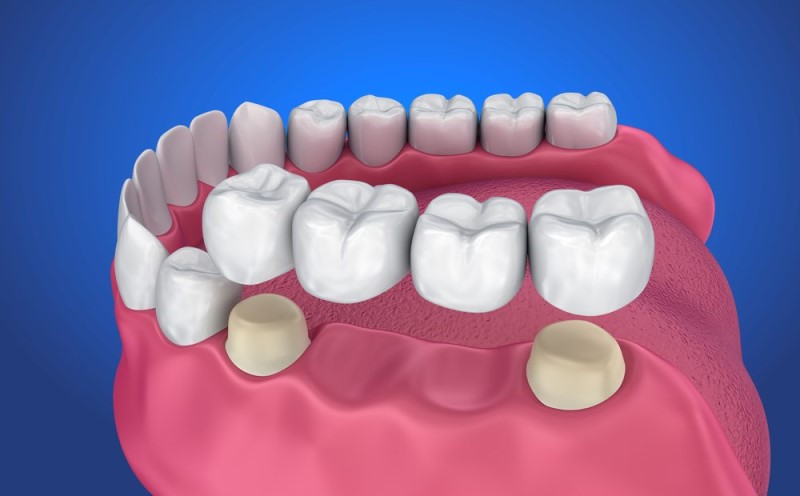 Trồng răng số 6 bằng cầu răng sứ sẽ giúp bạn đảm bảo tính chức năng nhai và tính thẩm mỹ