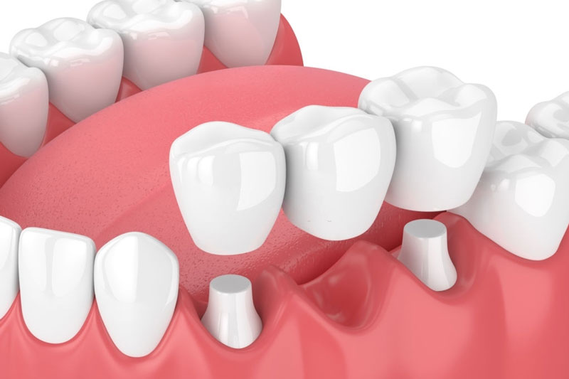 Kỹ thuật mài răng của bác sĩ không tốt có thể gây đau nhức khi trồng cầu răng sứ