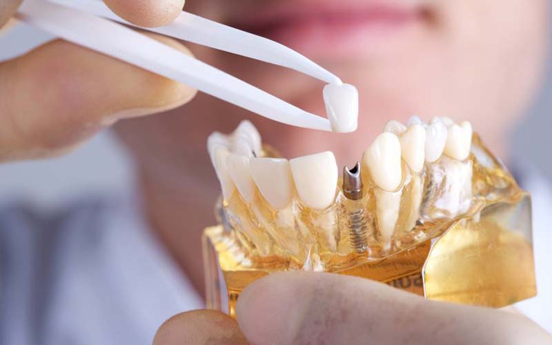 Trồng răng Implant hiếm khi gây ra cảm giác khó chịu cho người bệnh