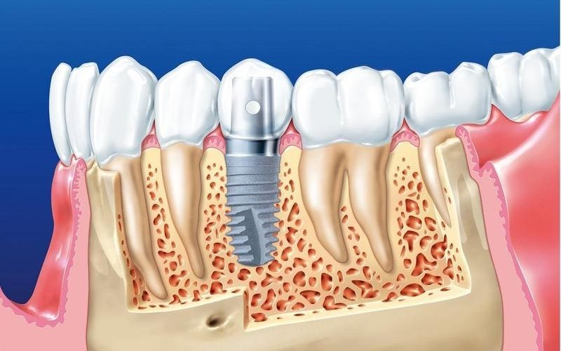 Cấy ghép Implant là phương pháp trồng răng giả cố định hiện đại nhất hiện nay