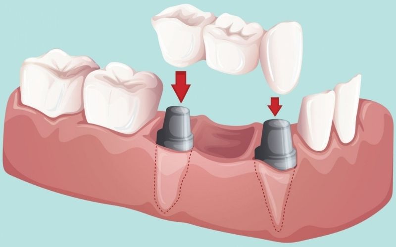 Bắc cầu răng sứ là phương pháp được nhiều người lựa chọn