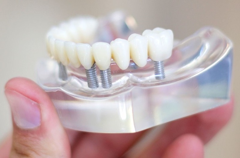 Trồng răng giả cố định là phương pháp giúp phục hình răng phù hợp với những trường hợp bị mất răng