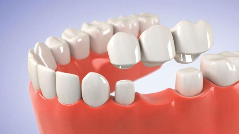 Với phương pháp cầu răng sứ, người bệnh chỉ mất khoảng 2 lần hẹn là đã hoàn thành