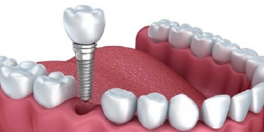 Tìm hiểu trồng răng giả vĩnh viễn bằng cấy ghép implant là giải pháp giúp phục hình răng miệng tốt nhất hiện nay