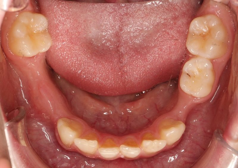 Người bệnh bị bị mất răng nên trồng lại càng sớm càng tốt
