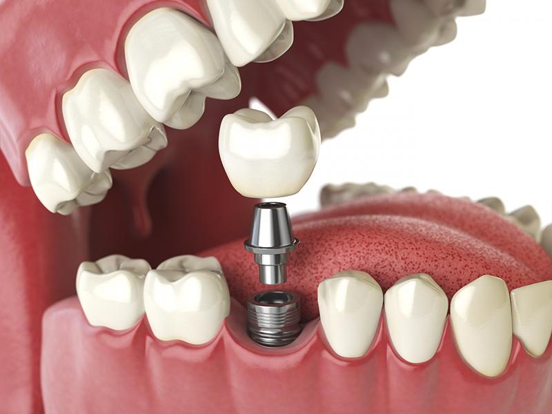 Cấy ghép Implant là phương pháp trồng răng hàm giả cố định