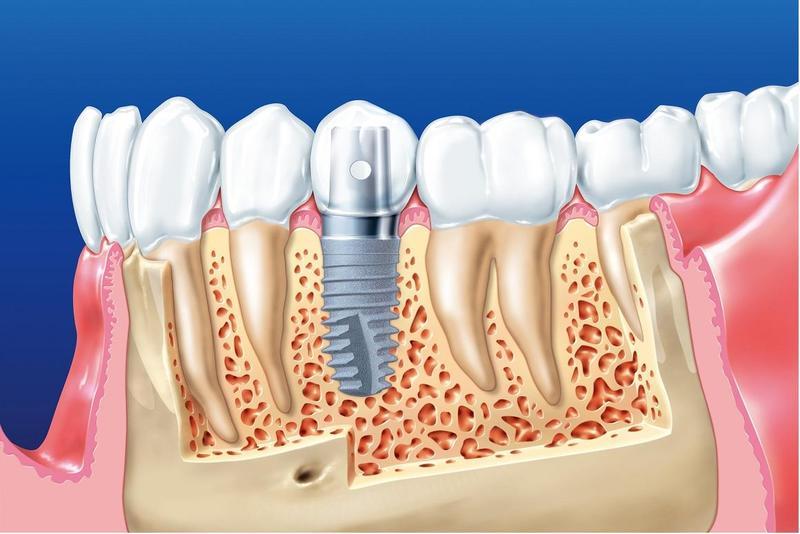 Trồng răng hàm có đau không khi cấy ghép implant